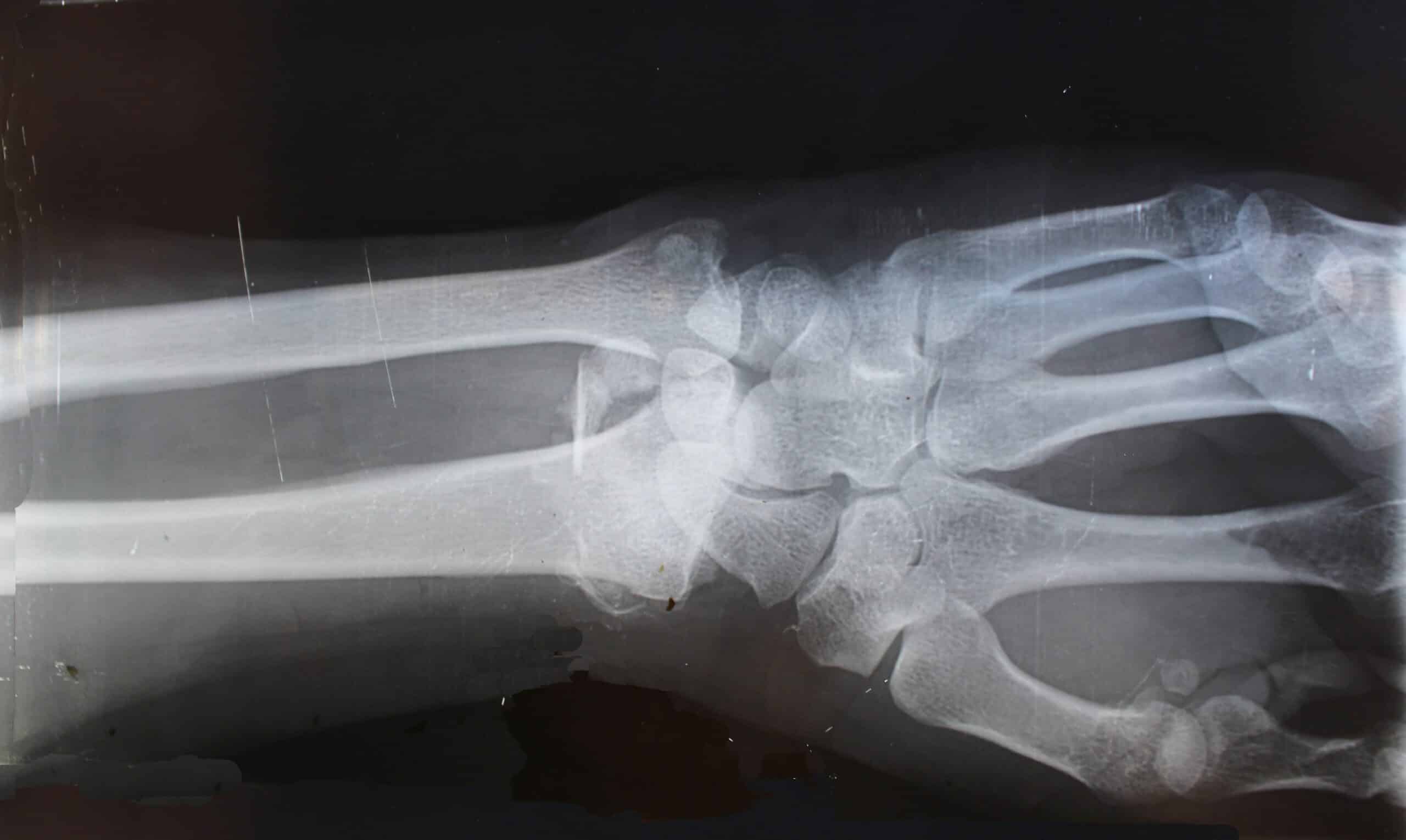 An x-ray of a person's arm and wrist bones.